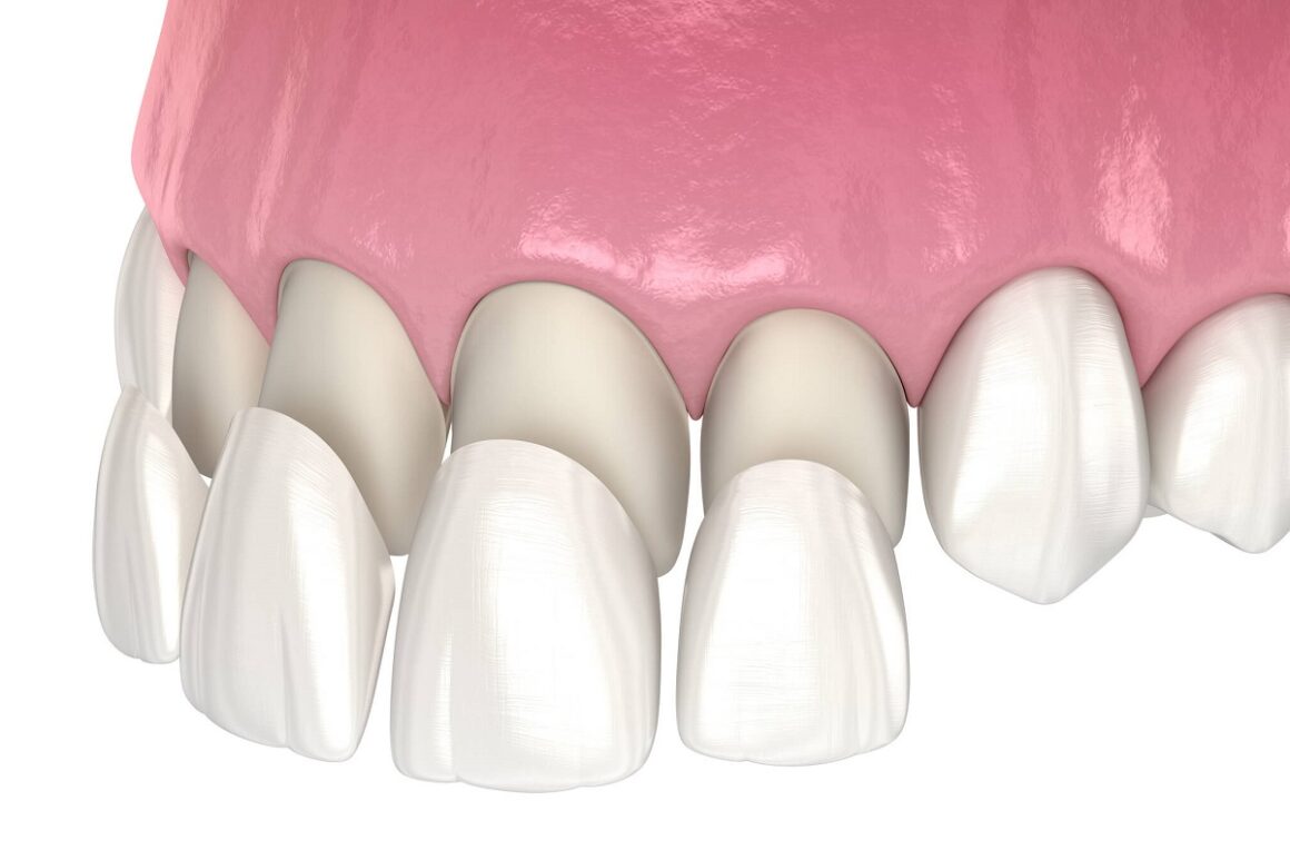 Dental-Veneers-Turkey Venner