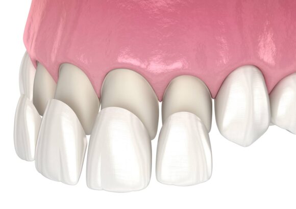 Dental-Veneers-Turkey Venner
