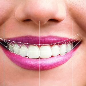 Smile Designing