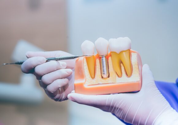 dentist-with-tooth-implant-false-teeth-dentistry-healthcare-concept-dental-clinic Restoration