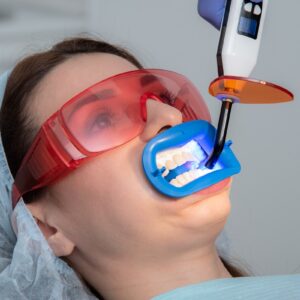 Preparing the oral cavity for whitening with an ultraviolet lamp. Close-up Bleaching