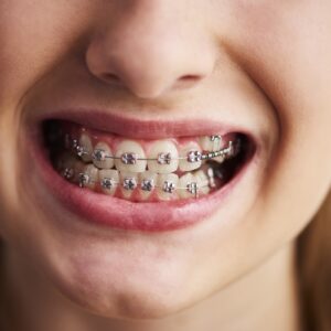 Braces Treatment