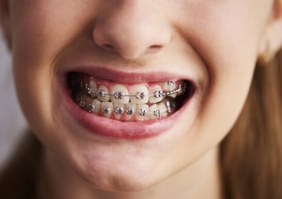 Shot of teeth with braces Braces Treatment