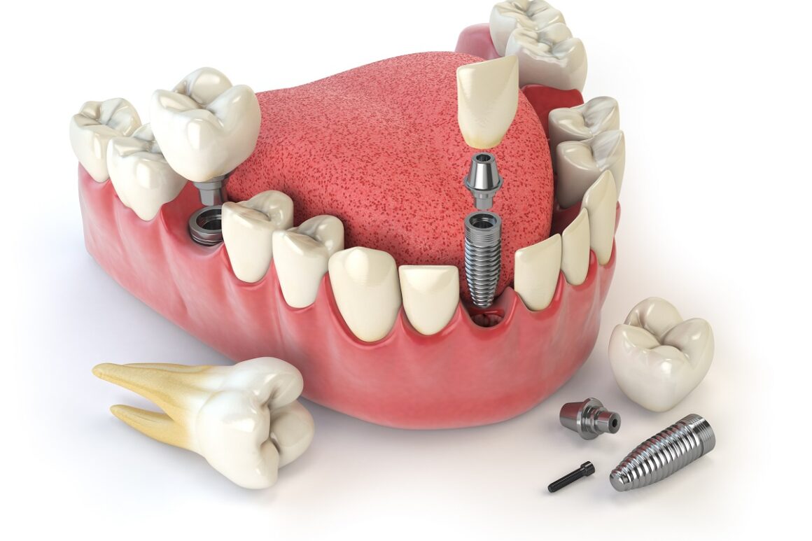 Implant