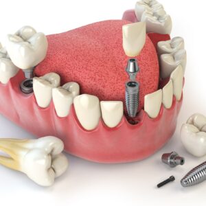 Tooth human implant. Dental concept. Human teeth or dentures. Implant