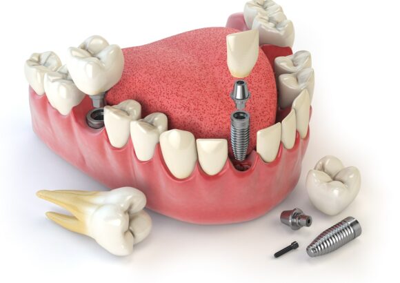 Tooth human implant. Dental concept. Human teeth or dentures. Implant