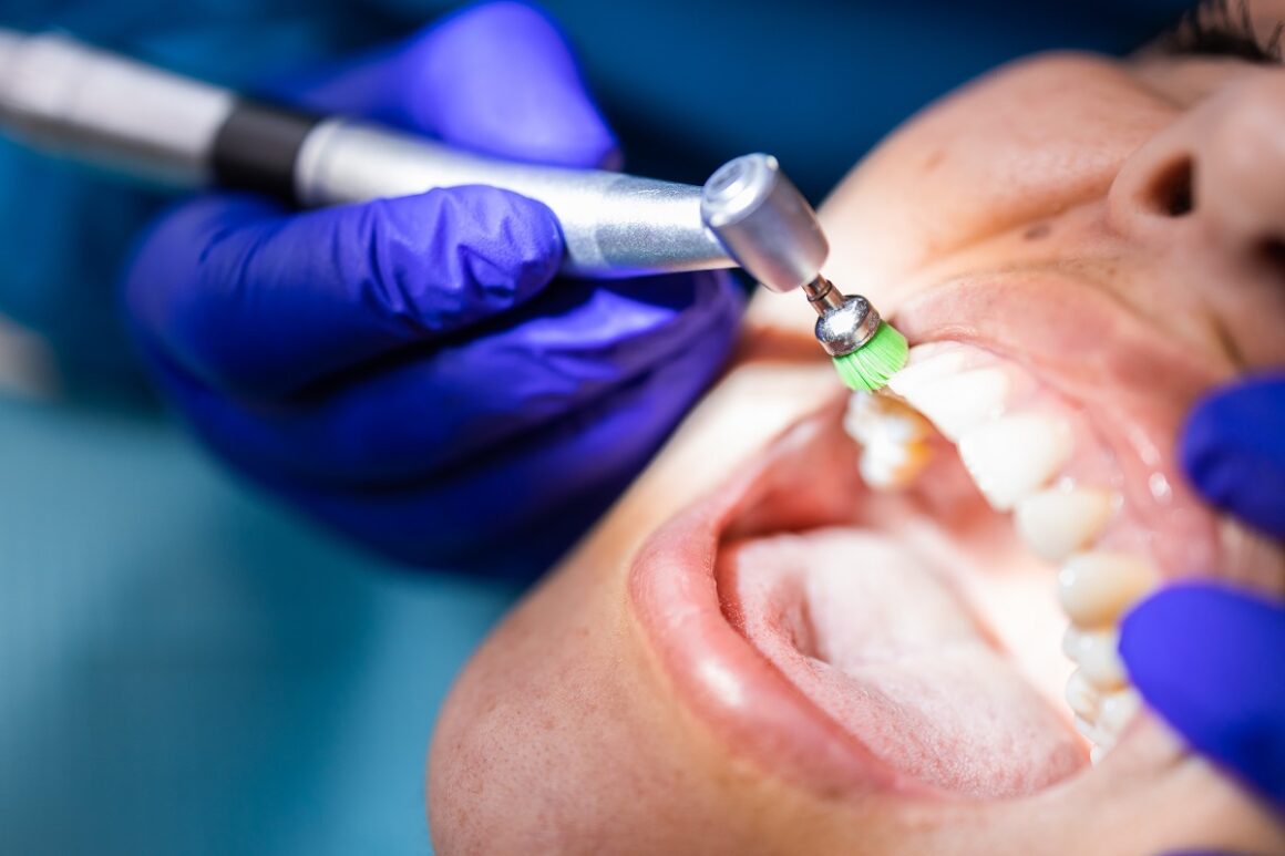 Cleaning of Teeth