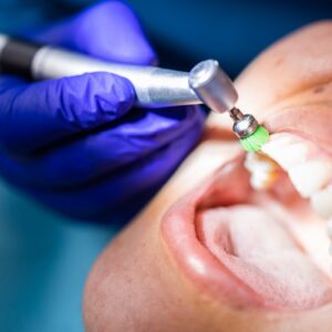 unrecognizable-dentist-using-dental-polishing-brush-polish-clean-female-patient-s-teeth Cleaning of Teeth