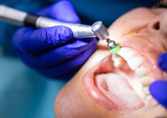 unrecognizable-dentist-using-dental-polishing-brush-polish-clean-female-patient-s-teeth Cleaning of Teeth