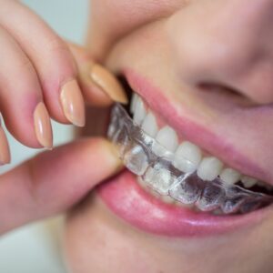 Clear Aligners