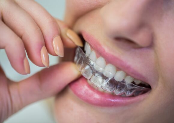 Close-up of woman wearing orthodontic silicone invisible braces Clear Aligners