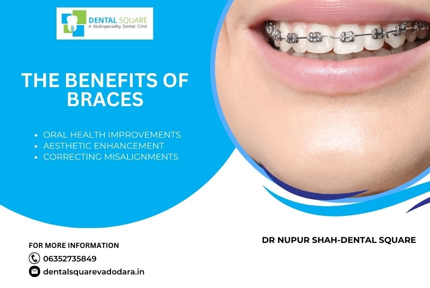 Best Braces Treatment in Vadodara 2024