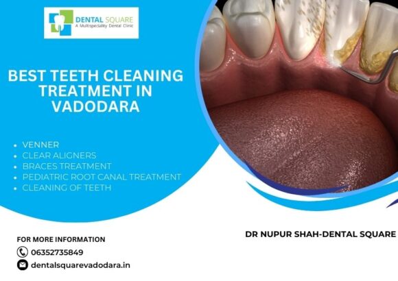 Best Teeth Cleaning Treatment In Vadodara 2024