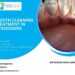 Best Teeth Cleaning Treatment In Vadodara 2024